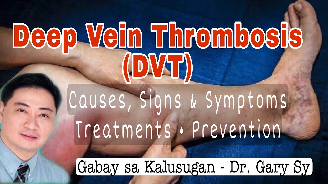 Deep Vein Thrombosis (DVT) - Dr. Gary Sy