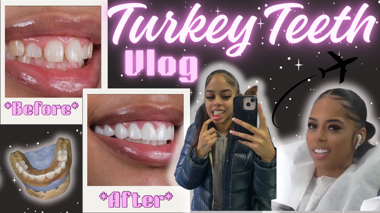 TURKEY TEETH VLOG ✈️ | 2 YEARS LATER! 