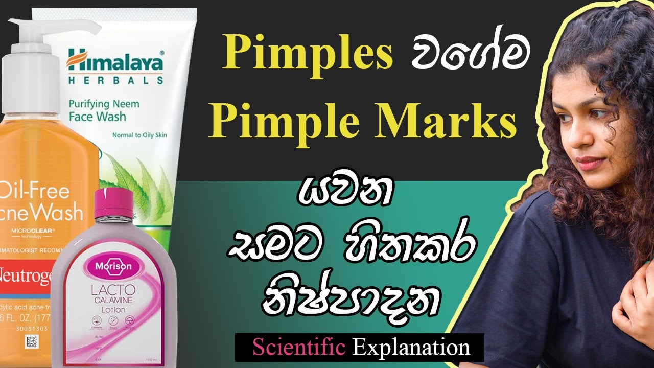 Skin Friendly Products for Get Rid from Acne - Sinhala Review කුරුලෑ වලට හොදම විසදුම