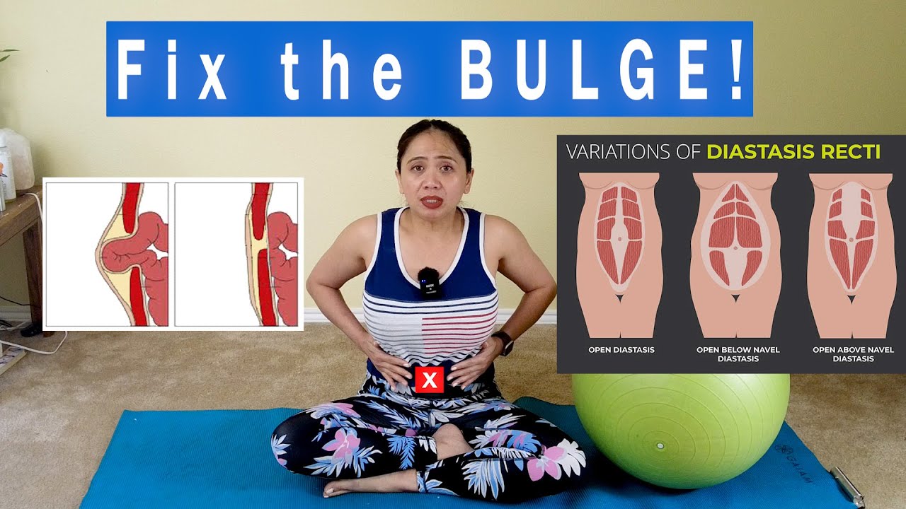 5 BEST Ways And Exercises to Fix the BULGE for GOOD! Abs Separation due to Hernia Diastasis Recti