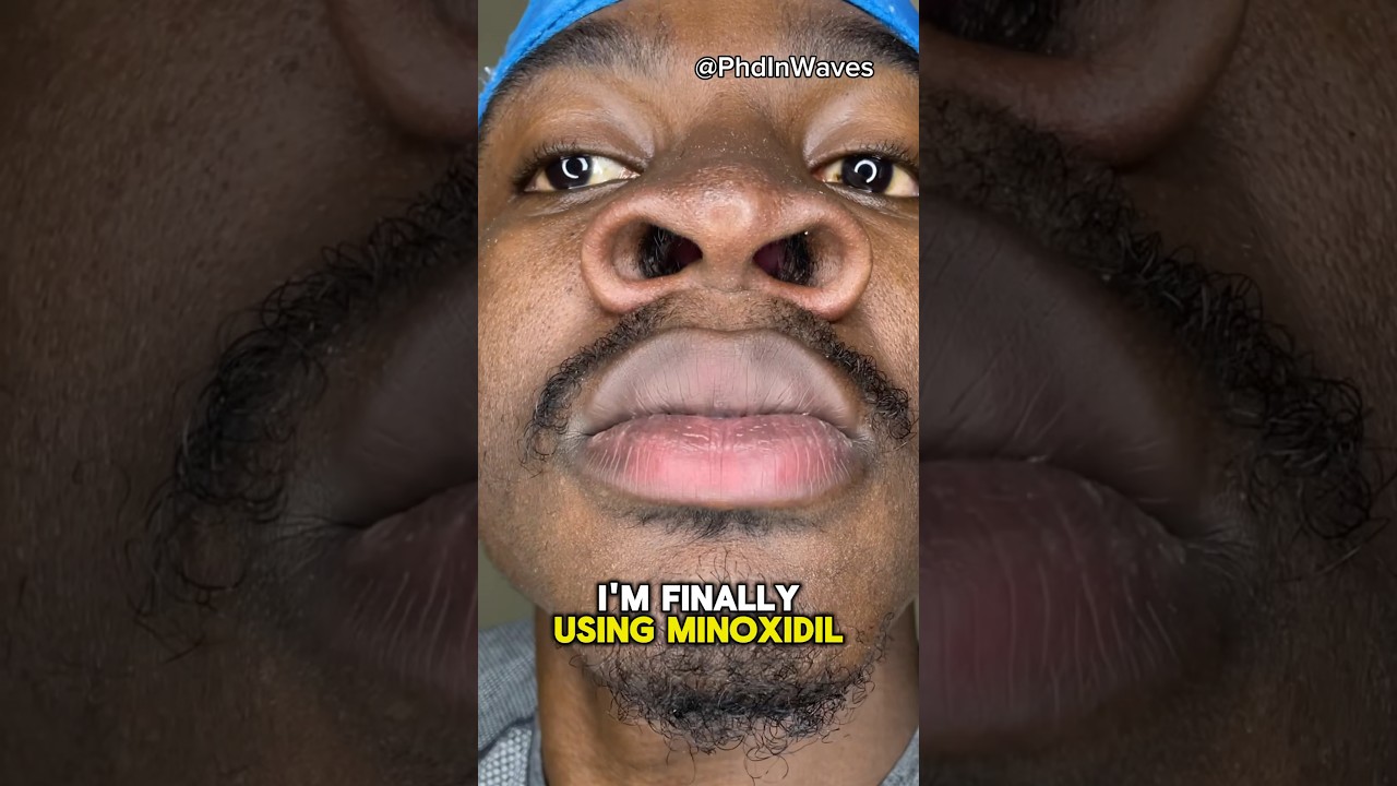 Beard Growth Journey #dermaroller #minoxidil