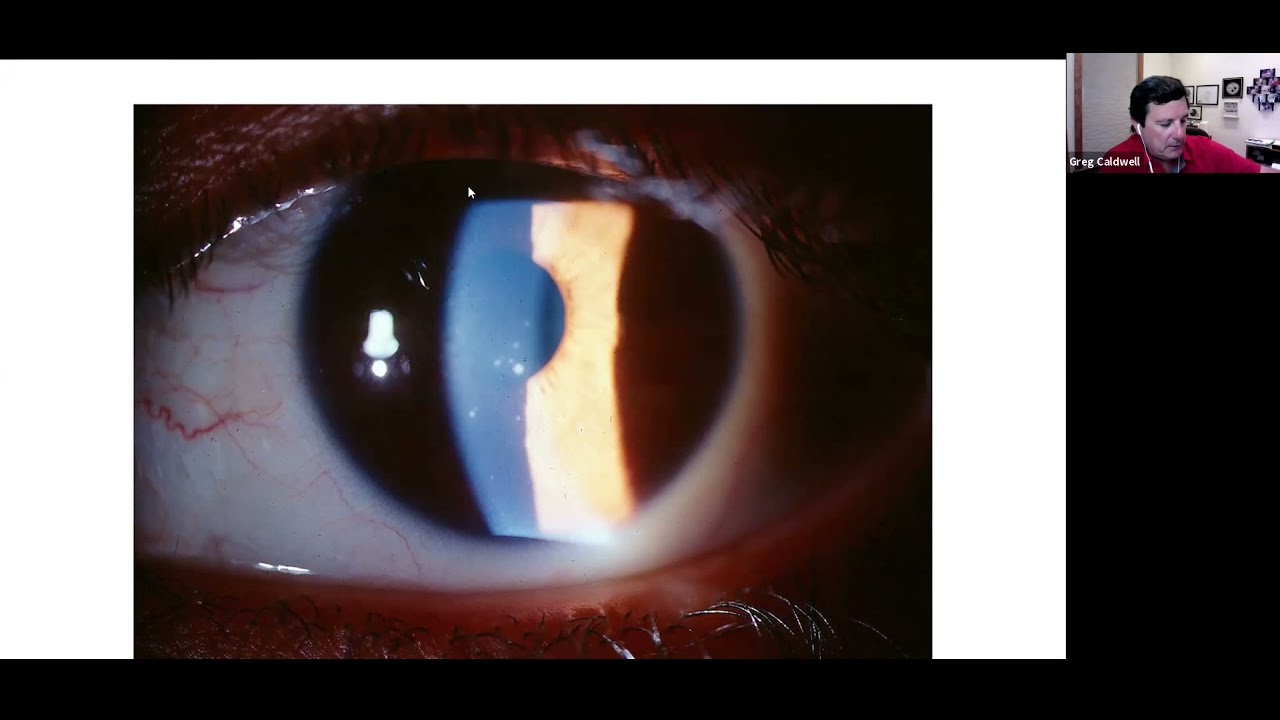 Glaucoma Gauntlet Managing the Challenging Cases