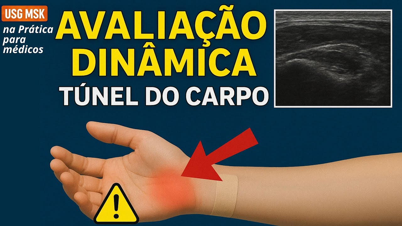 AULA PRÉ-EVENTO JORNADA DE EXCELÊNCIA NA USG MSK: Pós-Operatório do Túnel do Carpo: Como Investigar