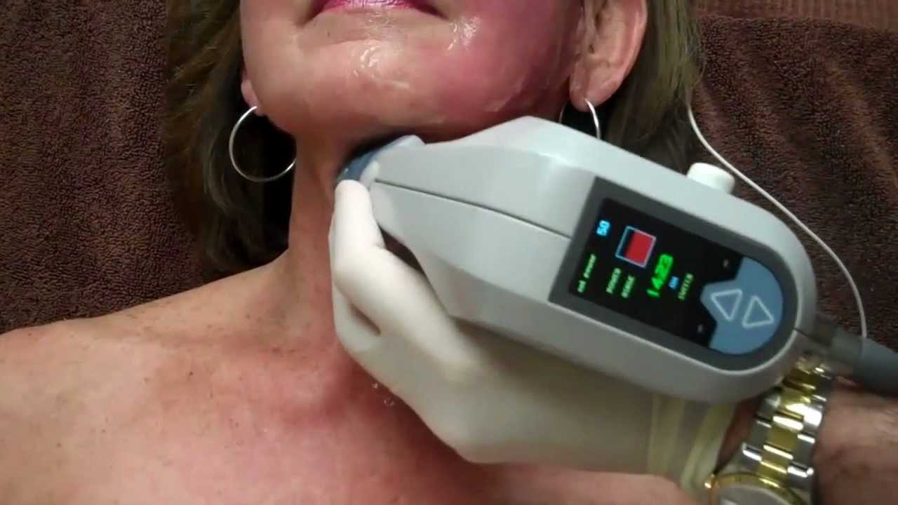 Exilis on Face & Neck for Skin Tightening with Dr. Seiler