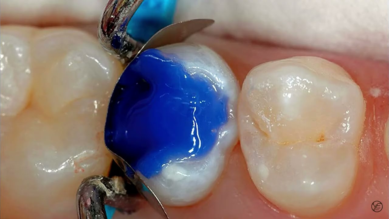 Biomimetic - Immediate Dentin Sealing | بروتوكول البوندنك