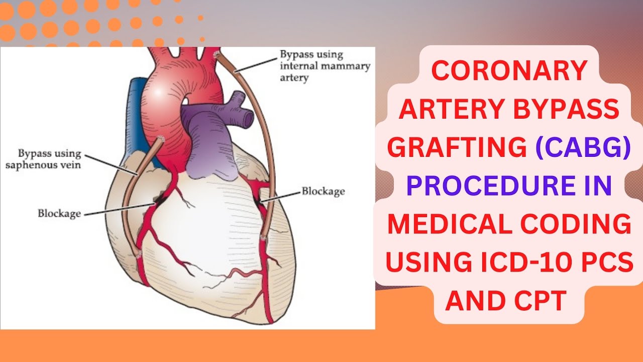 CORONARY ARTERY BYPASS GRAFTING (CABG) CODING IN ICD-10 PCS AND CPT