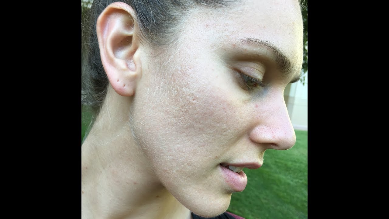 Why I Wash My Face With Dr Bronners Castile Soap (Acne Prone Skin) (PH, Acid, Oil, etc)