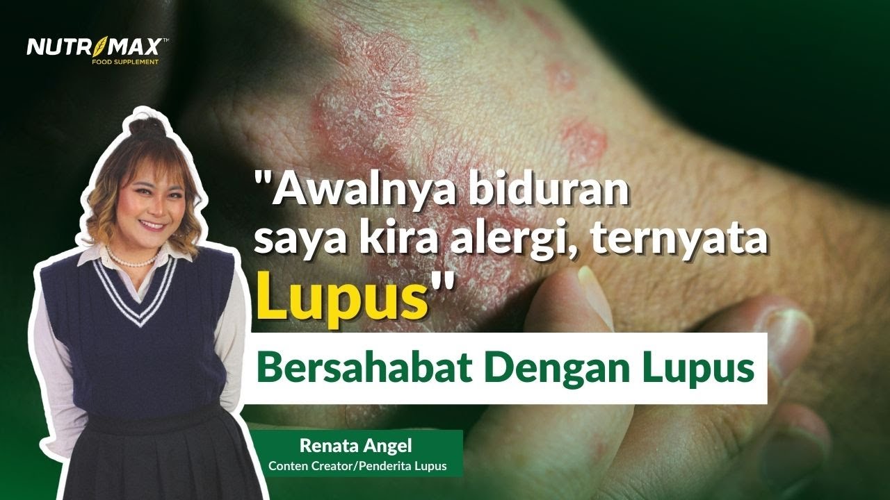Penyakit Lupus: Kisah Perjuangan Penderita Autoimun