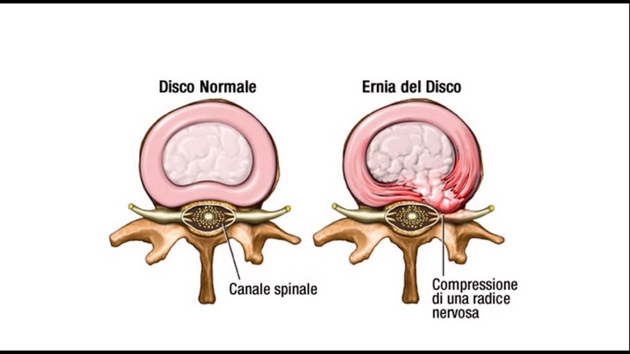 Le ernie discali lombari