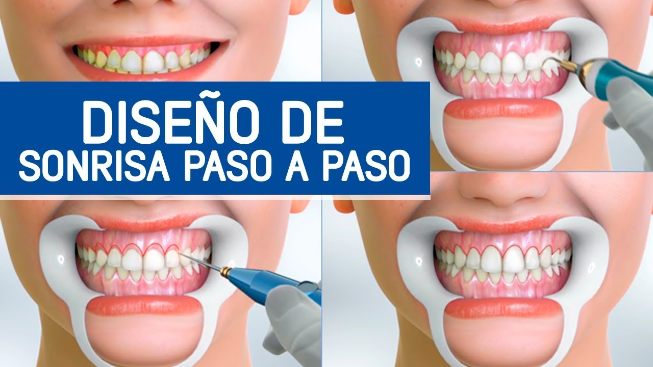 Diseño de sonrisa paso a paso / Odontoespecialistas