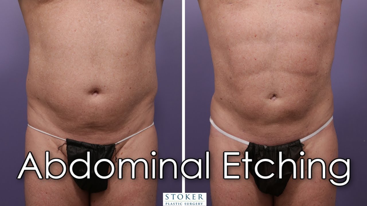Liposuction Los Angeles: Top Plastic Surgeon Dr. Stoker Reveals Keys to Performing Abdominal Etching