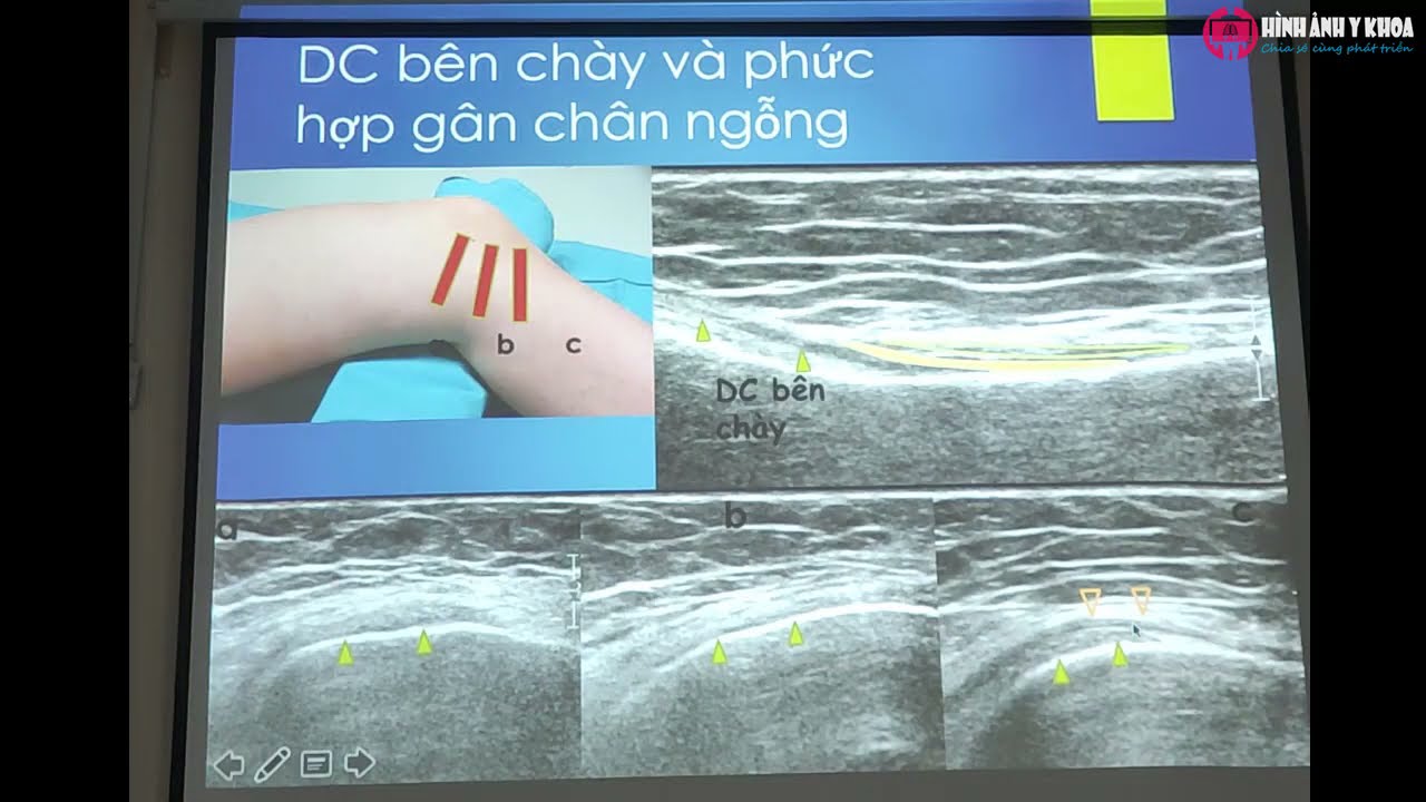 49. Siêu âm khớp gối – ThS.BS Nguyễn Thị Minh Trang (SATQ ĐHYD)