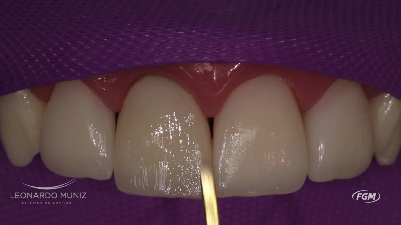 Faceta com resina composta Vittra APS e pino de Fibra de Vidro em dente escurecido