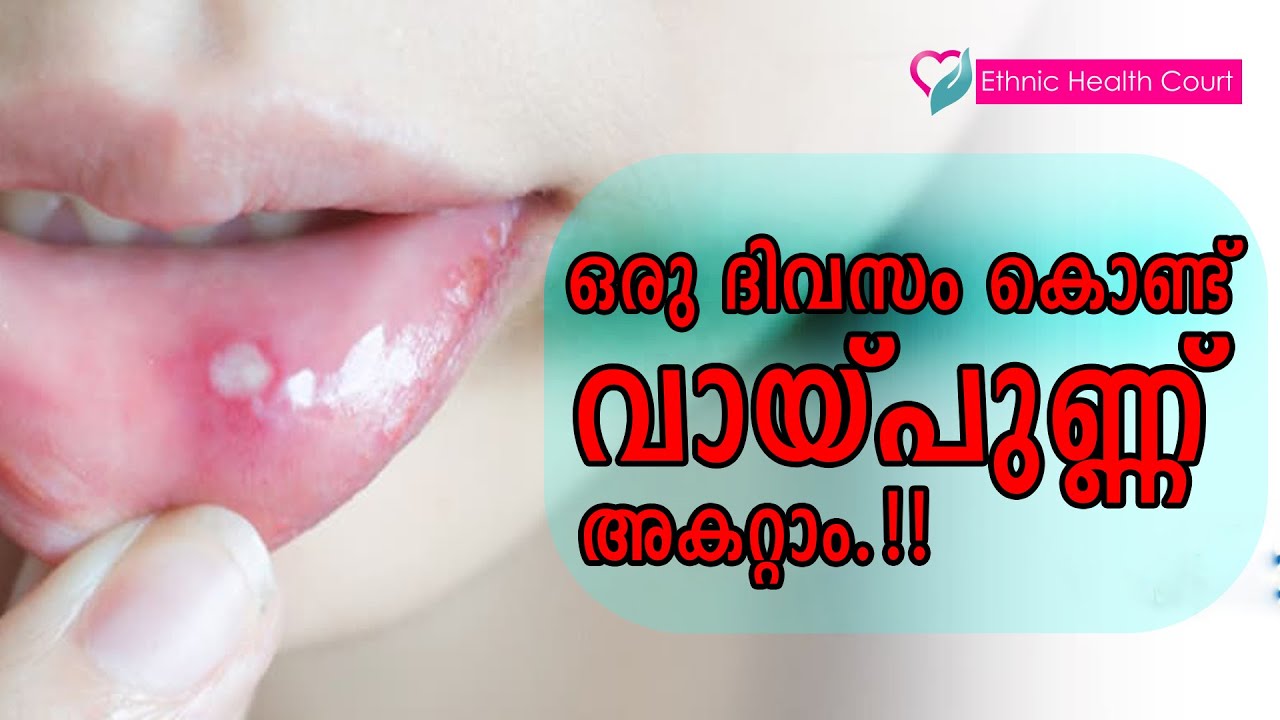 വെറും ഒറ്റ ദിവസം കൊണ്ട് വായ്പുണ്ണ് മാറ്റിയെടുക്കാം | mouth ulcer home remedy | Ethnic Health Court