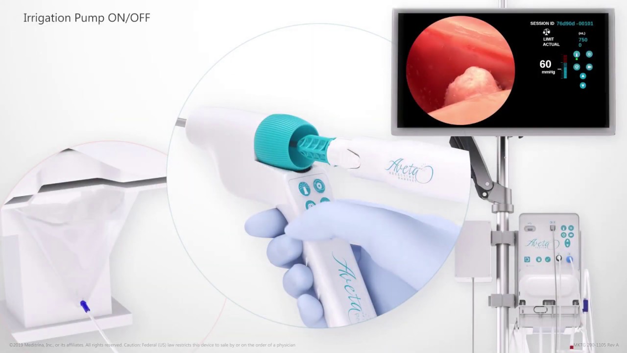 Aveta System Physician Control - Single Use Hysteroscopy lets you control your procedure