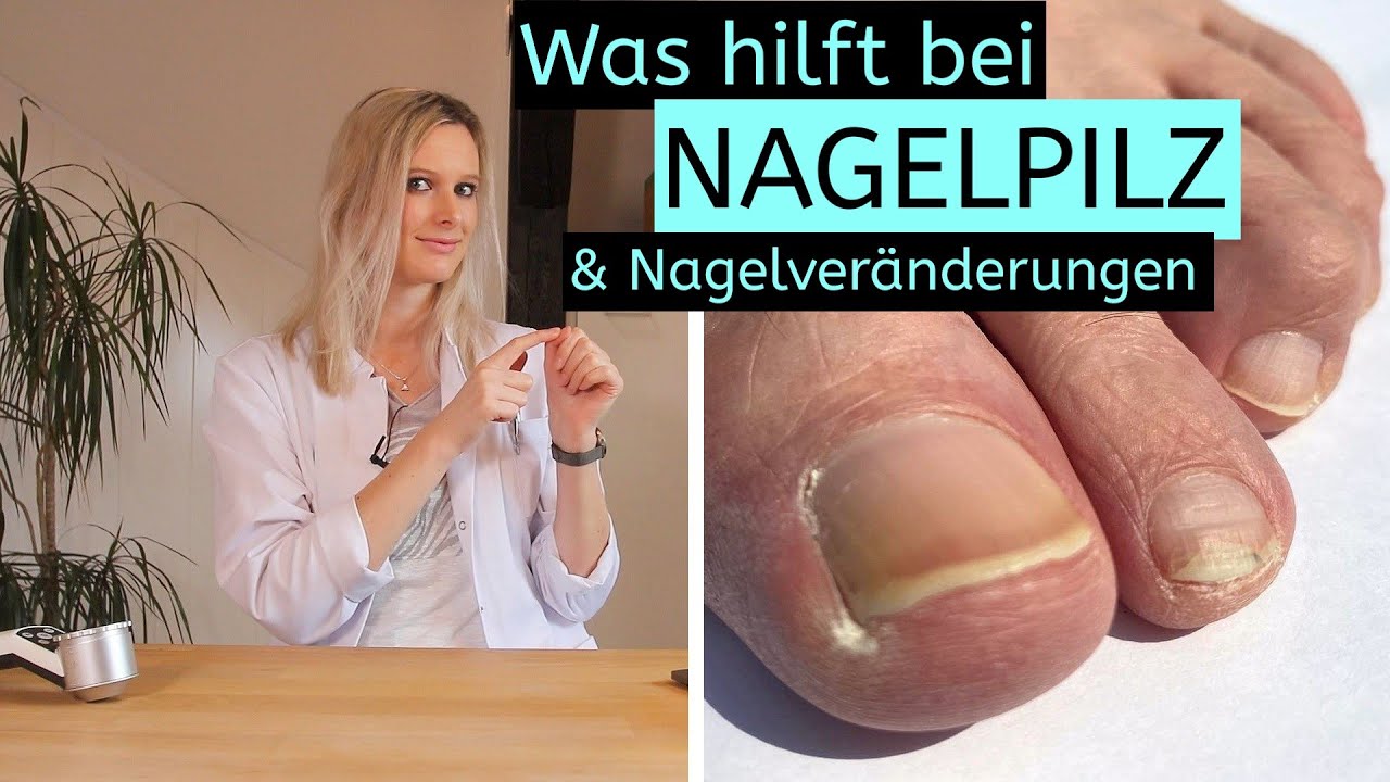 Was hilft bei Nagelpilz und Nagelveränderungen | Hintergründe | Tipps | Erklärungen