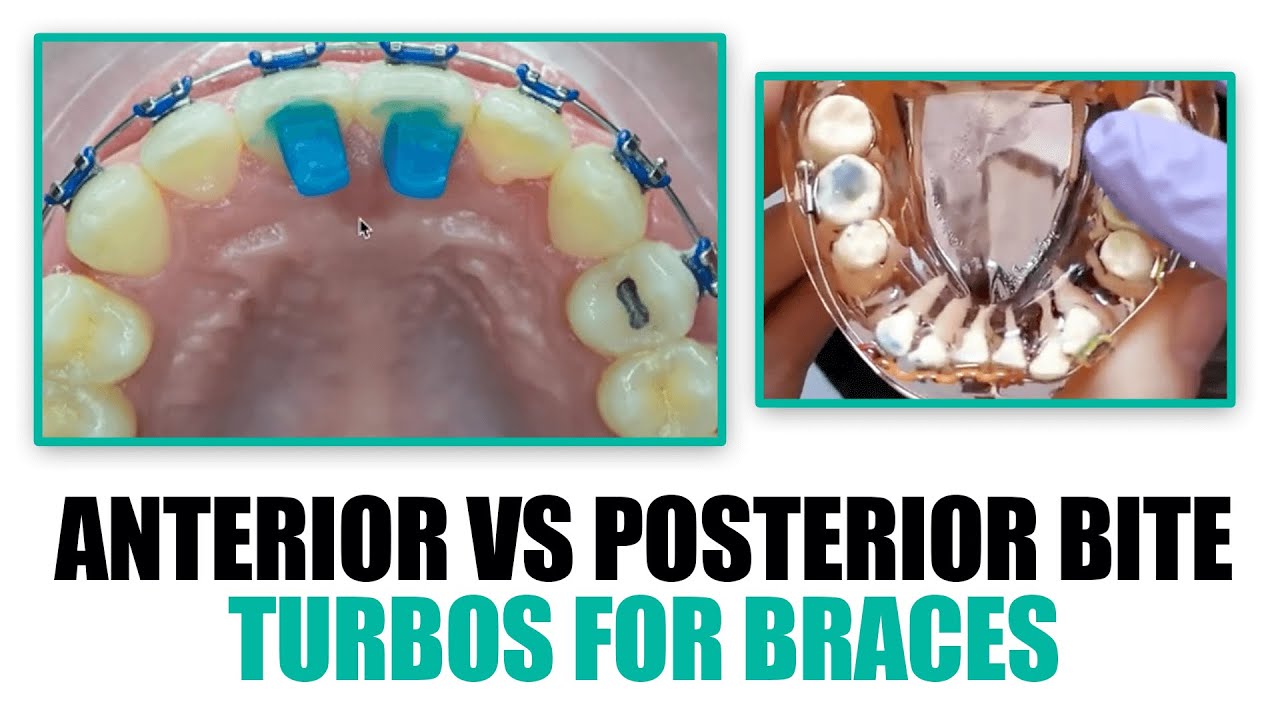 Anterior Bite Turbos vs Posterior Bite Bumps