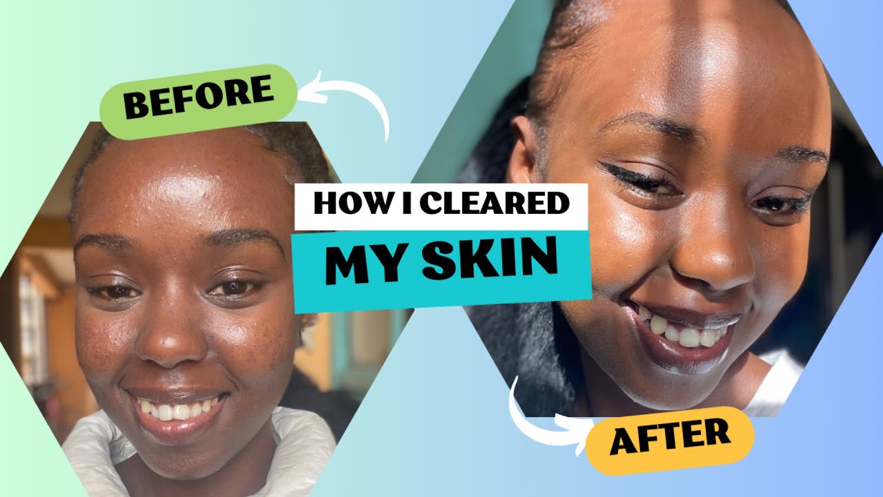 How I Cleared my skin ft CeraVe and Tretinoin