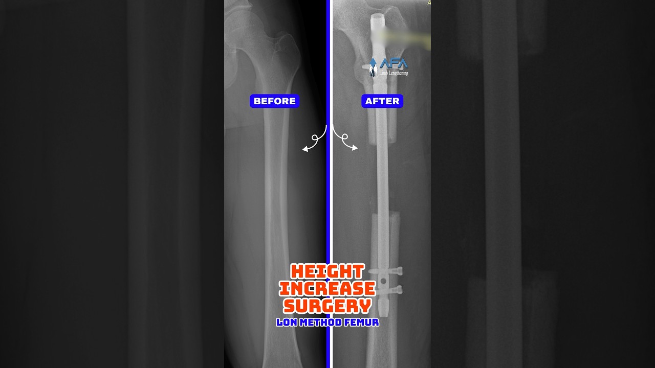 X-RAY / LON METHOD FEMUR/ HE GOT 7.2 CM TALLER! 