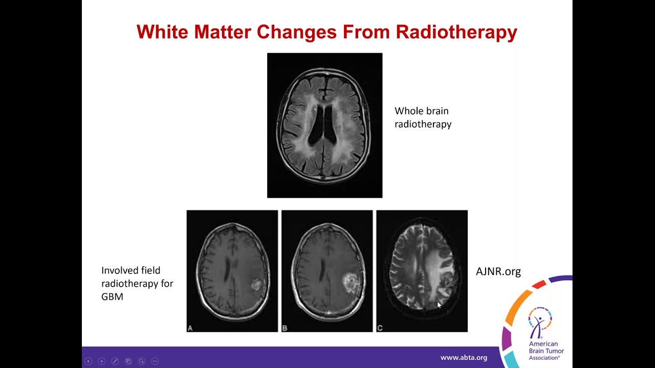 Long-Term Side Effects of Brain Tumor Treatment