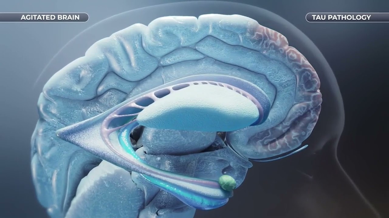 Agitation associated with Alzheimer&rsquo;s Dementia: Mechanism of Disease