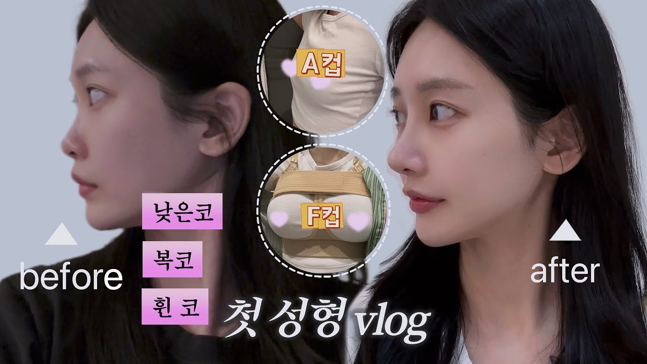 두 번은 절대 없을 코 수술+가슴수술 ㄹㅇ솔직 후기 | 수술 당일부터 8일차까지 회복 기록 | 자가늑 +모티바 수술