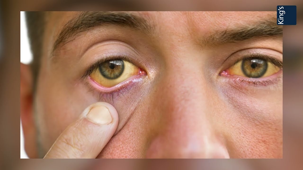 Jaundice Explained | Dr. Kaiser Raja at King’s Dubai