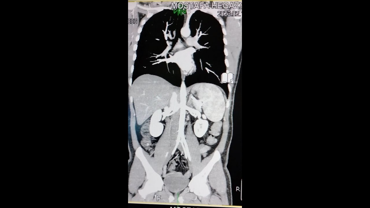 الاشعه المقطعيه علي الشريان الاورطي بالصبغه/ CT angiography of aorta part 1
