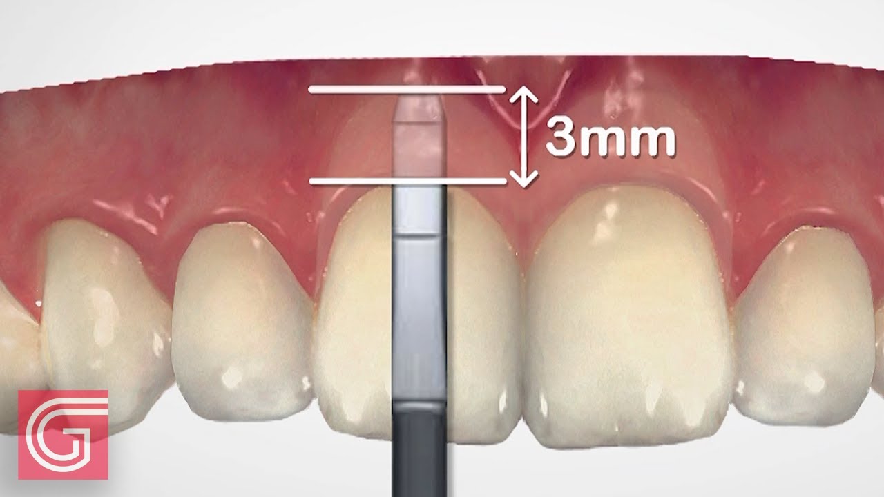 HOW TO Use #Dental Bone Sounding Gauge BEFORE #Gingivectomy