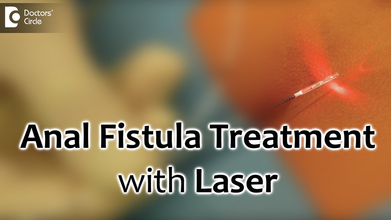 Anal Fistula Treatment with Laser. Painless and best recovery for fistula - Dr. Rajasekhar M R