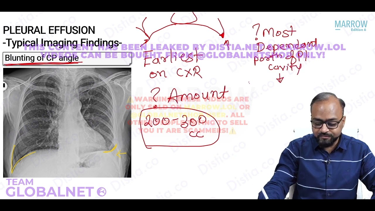 12 Pleural abnormalities & lobar collapse