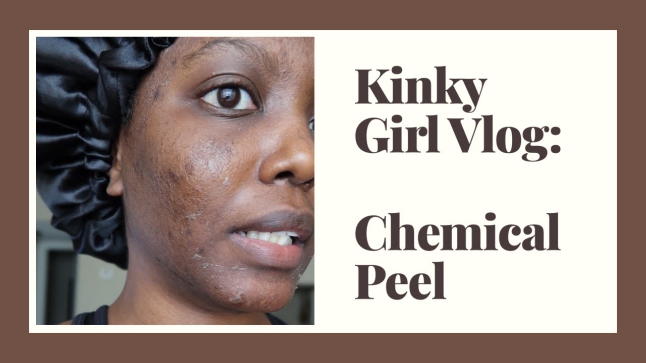 A Kinky Girl Vlog&mdash;Chemical Peel on Black Skin