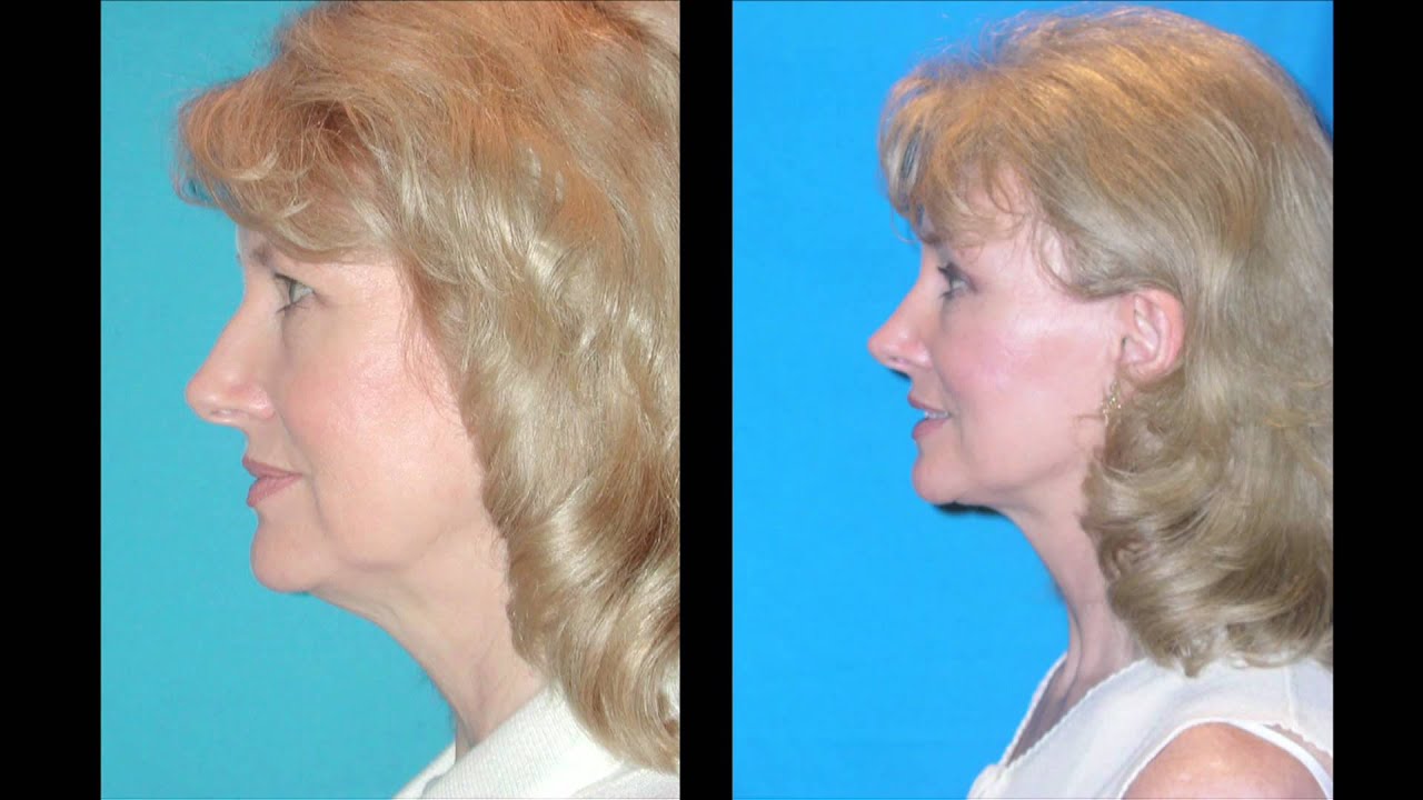 NASHVILLE FACIAL PLASTIC SURGERY Facelift, Browlift, Eyelid Lift, Nasal Surgery Before and Afters