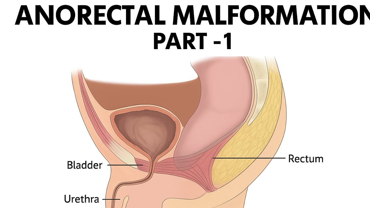 ANORECTAL￼ MALFORMATION | ANORECTAL DEVELOPMENT | ARM | CLASSIFICATION | CONGENITAL POUCH COLON|
