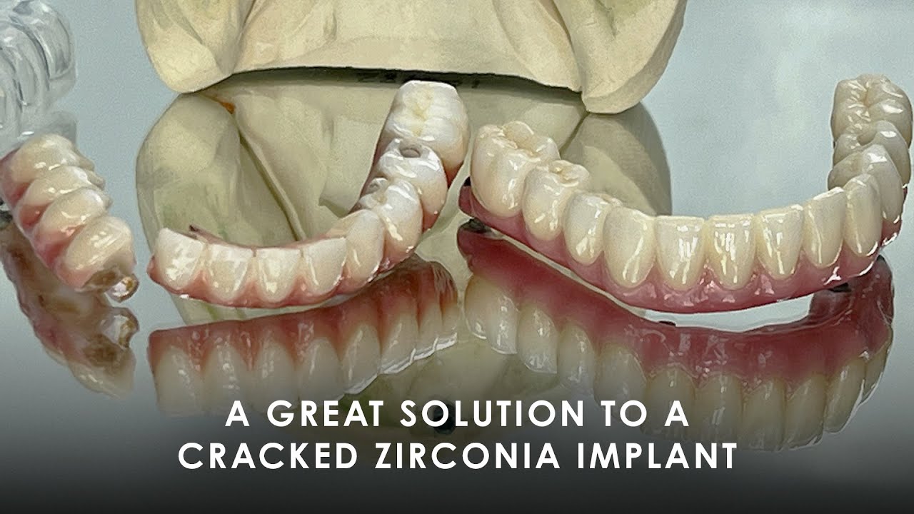 A Great Solution to a Cracked Zirconia Implant