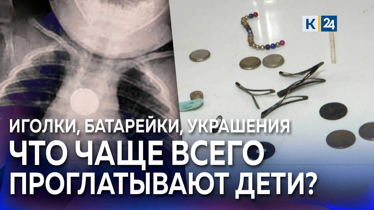 Что делать, если ребенок проглотил инородный предмет? Иглы, магниты и батарейки в детских желудках