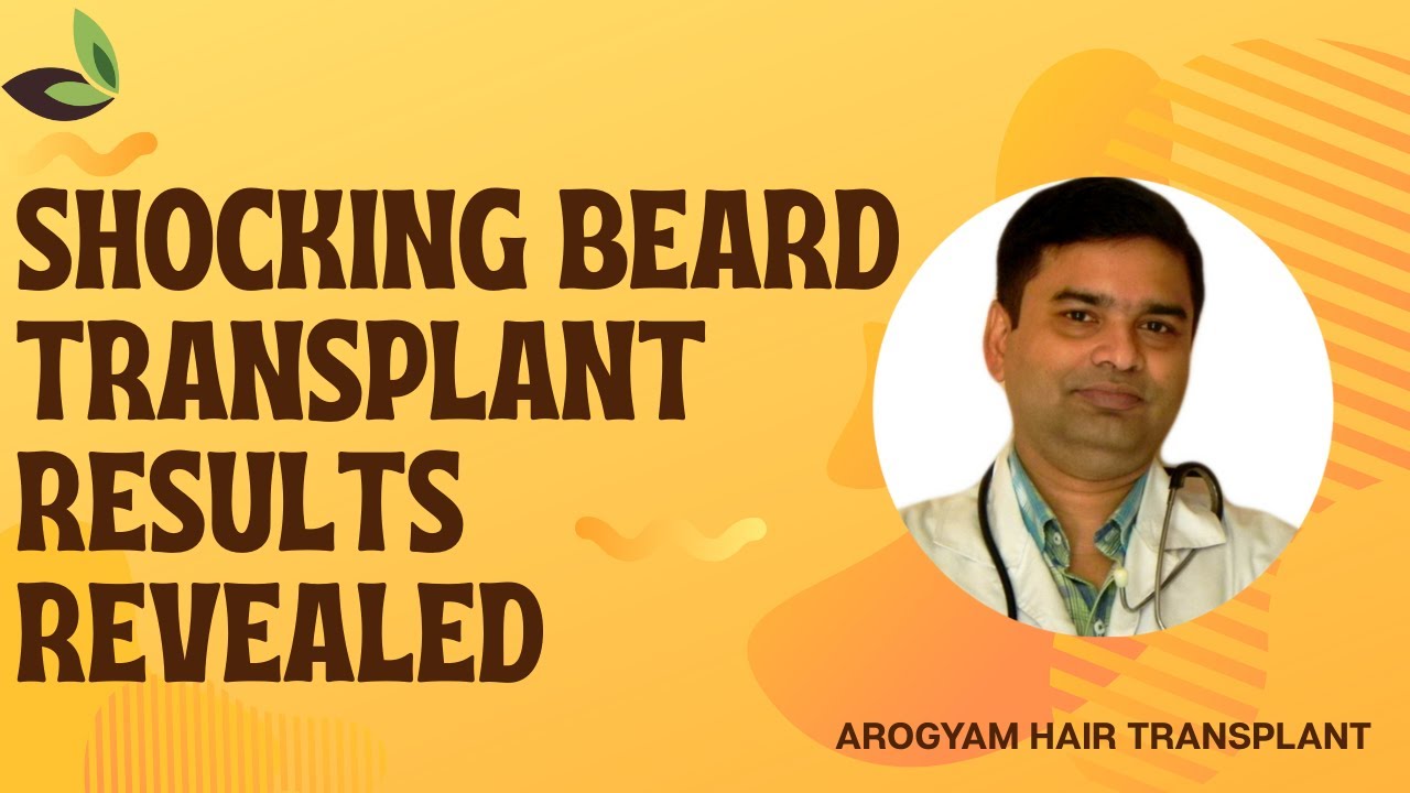 Shocking Beard Transplant Results Revealed | Arogyam Guwahati