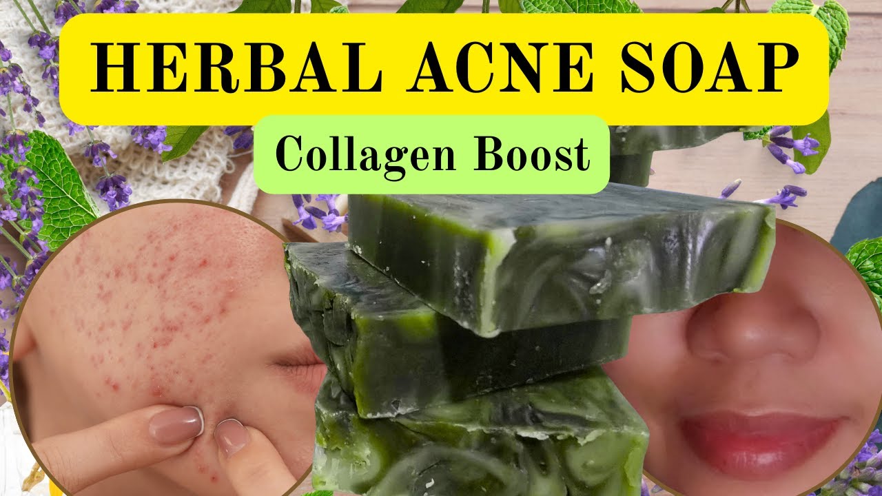 How I Make a Powerful Herbal Acne & Collagen Soap