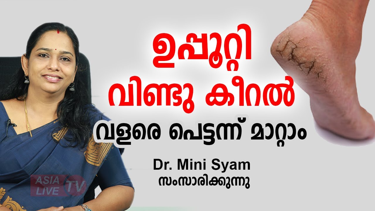 ഉപ്പൂറ്റി വിണ്ടു കീറൽ വളരെ പെട്ടന്ന് മാറ്റാം Treatment and prevention of Cracked heels Health Tips