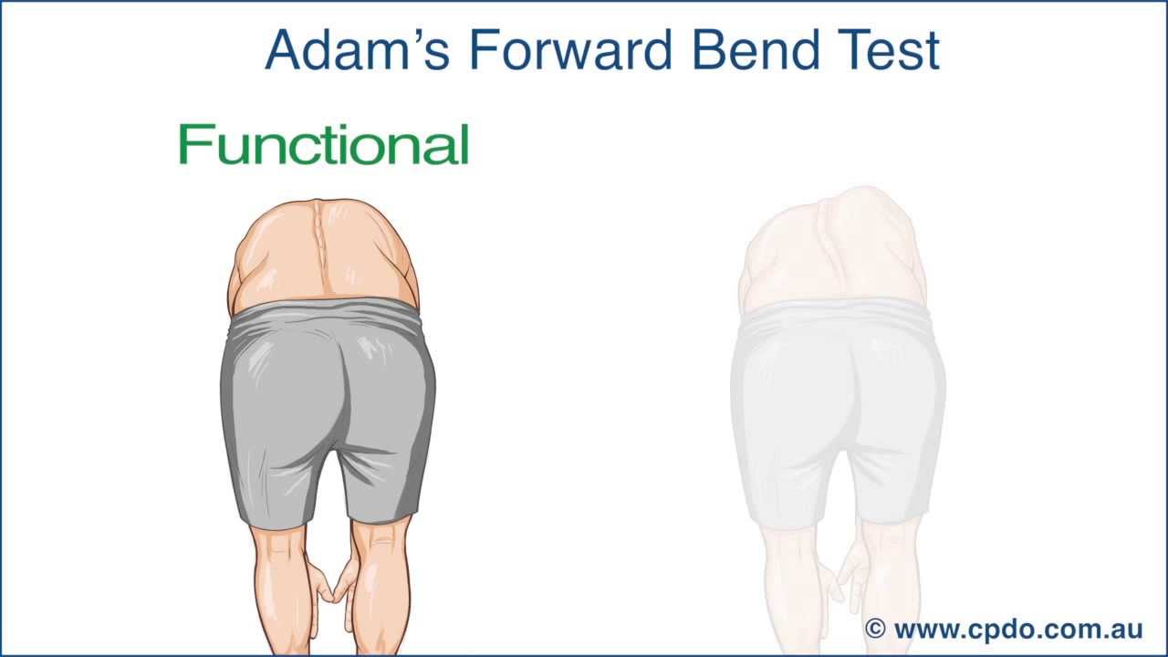 Adam's Forward Bend Test - A Chiropractic Online CE&trade; Production