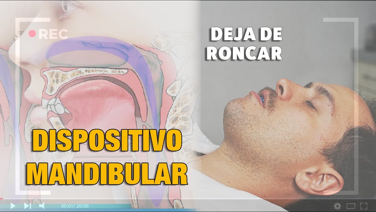 Cómo funciona el Dispositivo de Avance Mandibular?