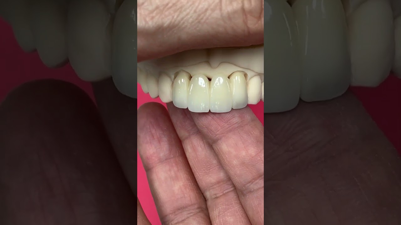 Anterior Pontic Bridge @EnvisiontecMain #envisiontec