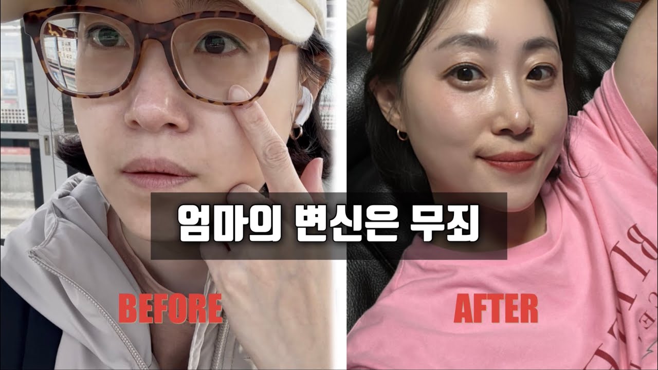 Vlog. 10년을 벼르고 벼른 성형수술을??!! 드디어 눈밑지!!!