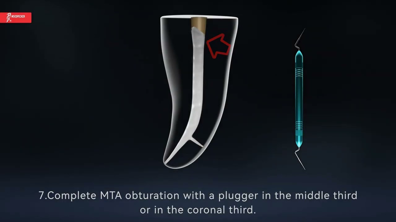 How to fill the root canal with 812MT/812MTを用いたMTA根管充填