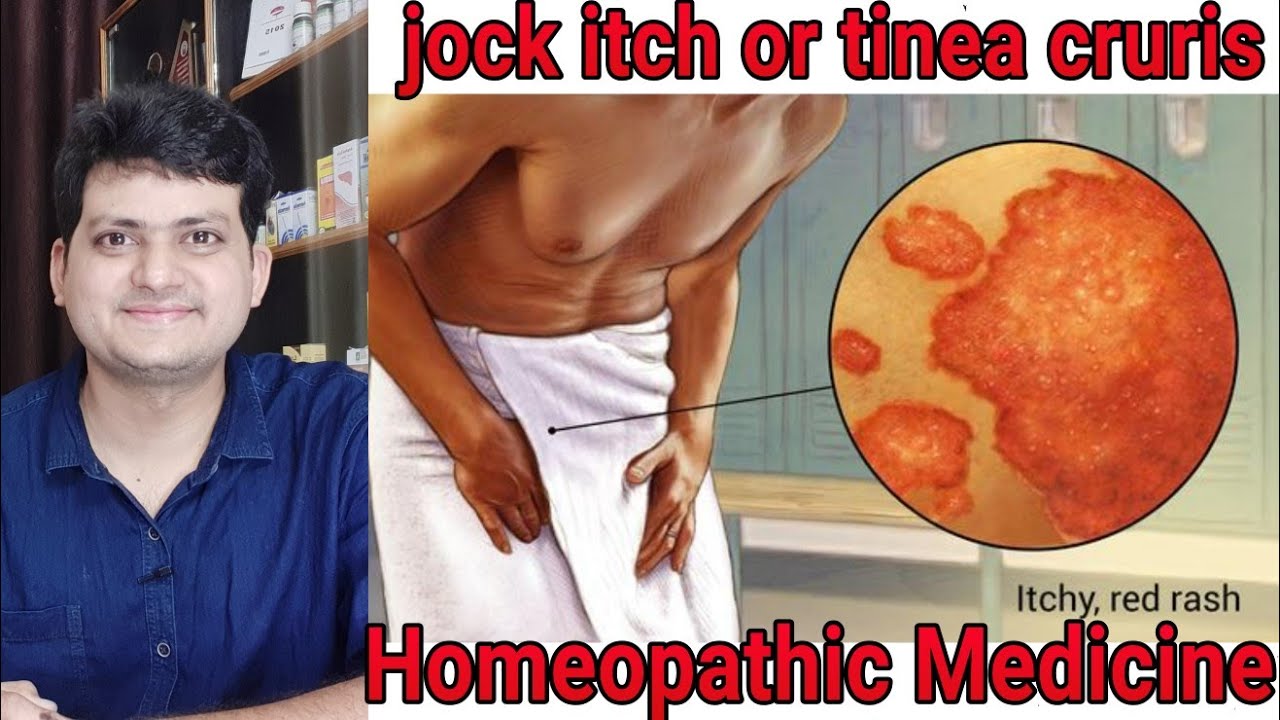 Jock itch | fungal infection | Homeopathic Medicine for tinea cruris ? explain !