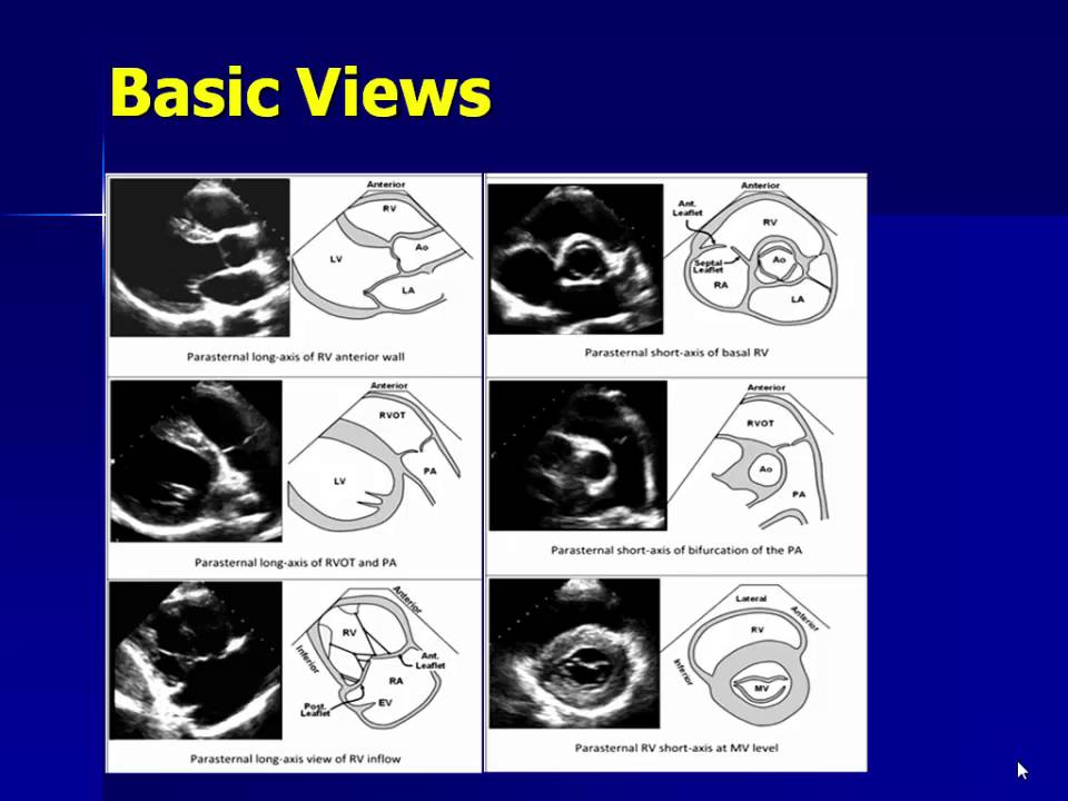 Echocardiography of The right ventricle