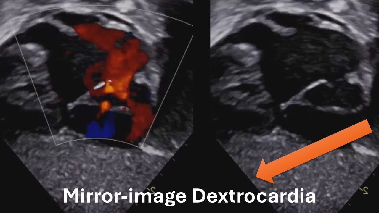 Mirror-image Dextrocardia in Echocardiography, how to image correctly?