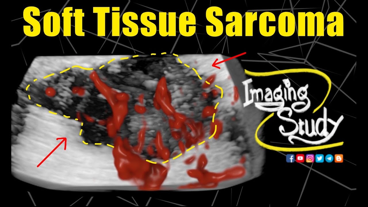 Soft Tissue Sarcoma || Ultrasound || Case 321