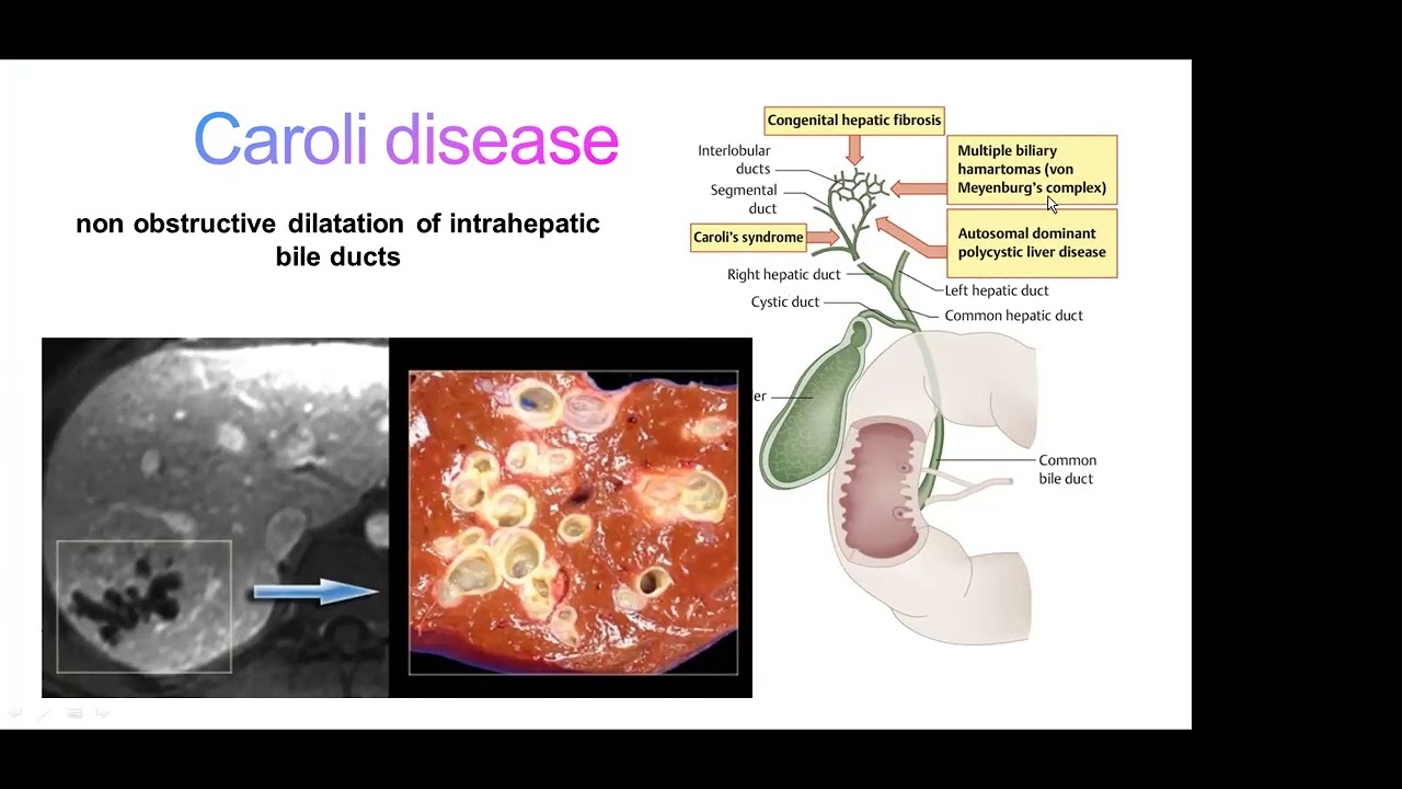 Caroli disease