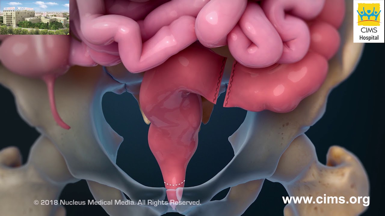 Rectum Removal &ndash; CIMS Hospital